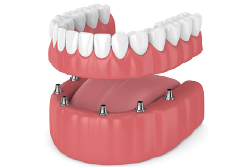 trenton-dental-implants