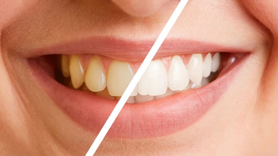 How To Get Brighter Teeth For Life
