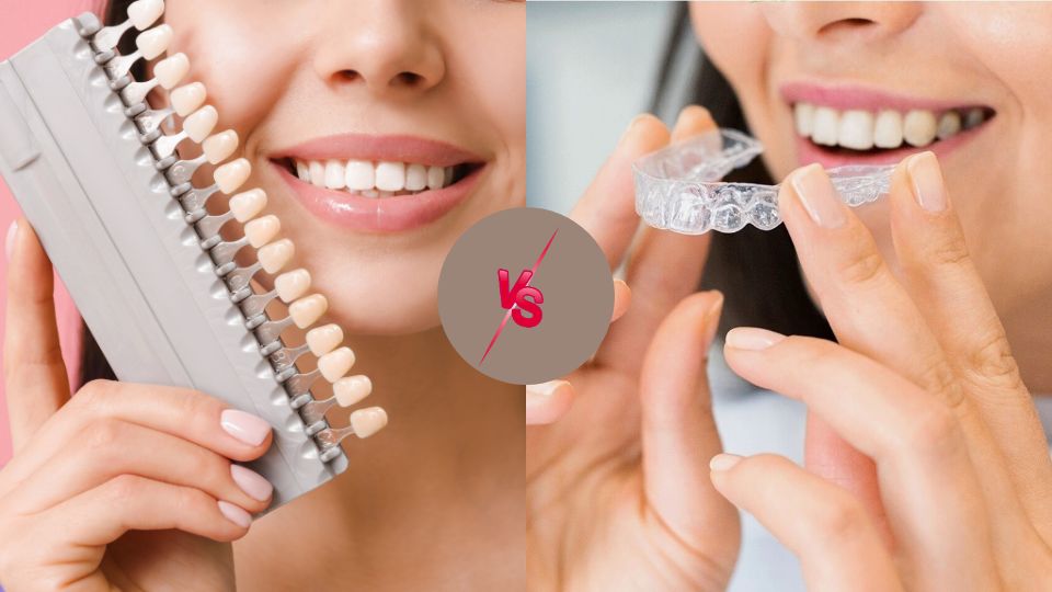 Veneers Vs. Invisalign: Which Is Best For You?