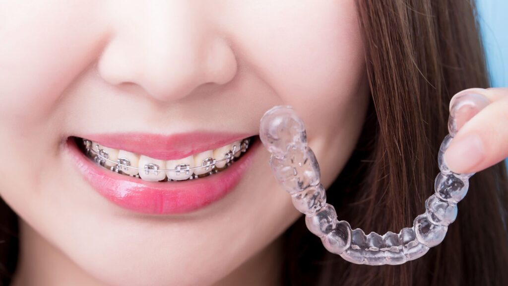 Comparing Traditional Braces And Invisalign