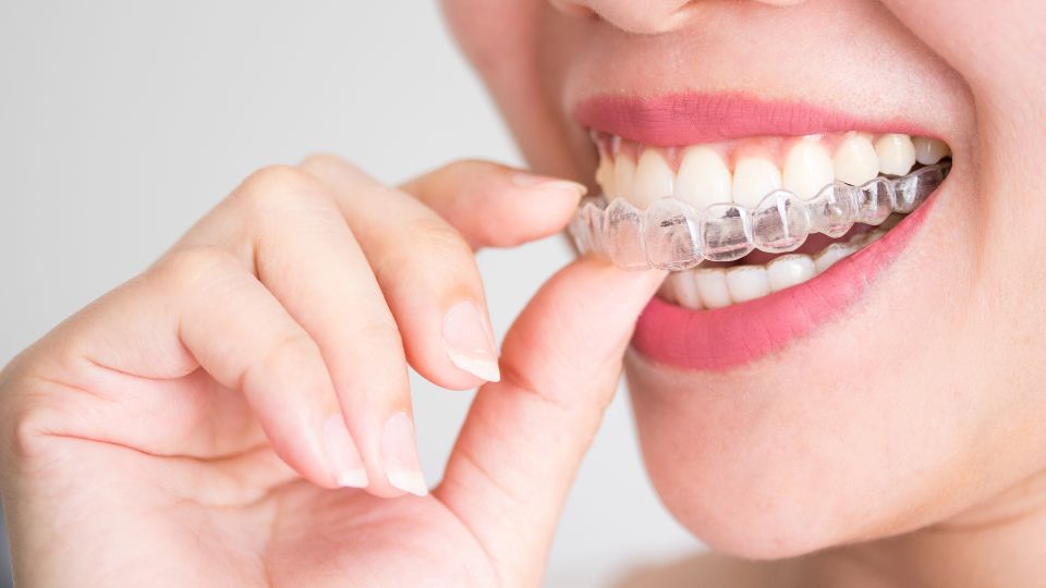 Close-Up of Woman Fitting Invisalign