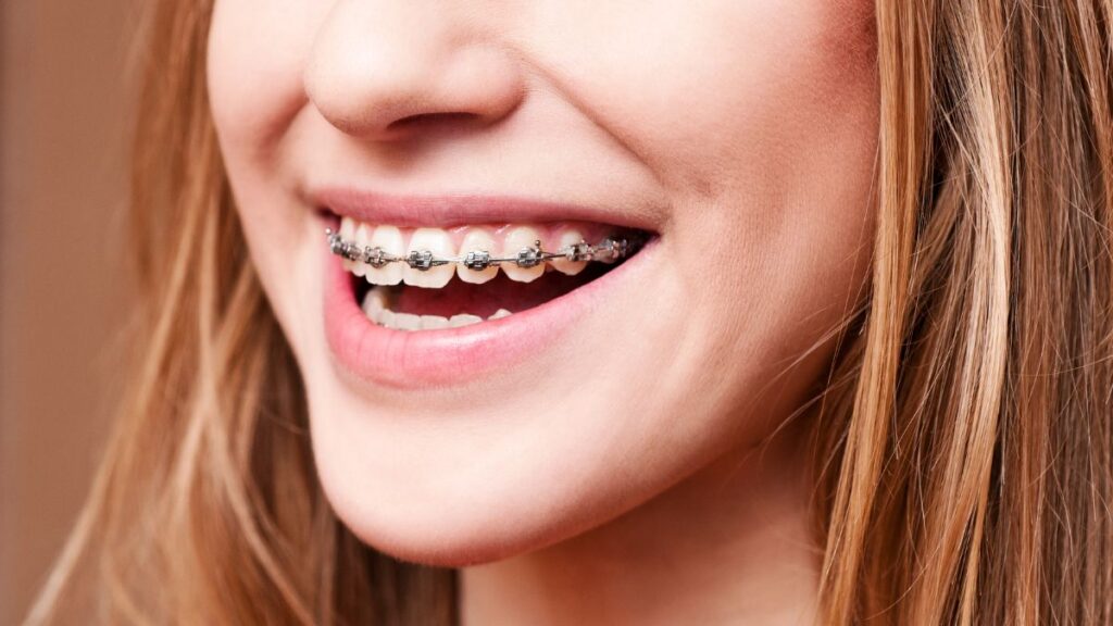 Woman Smiling with Her Braces