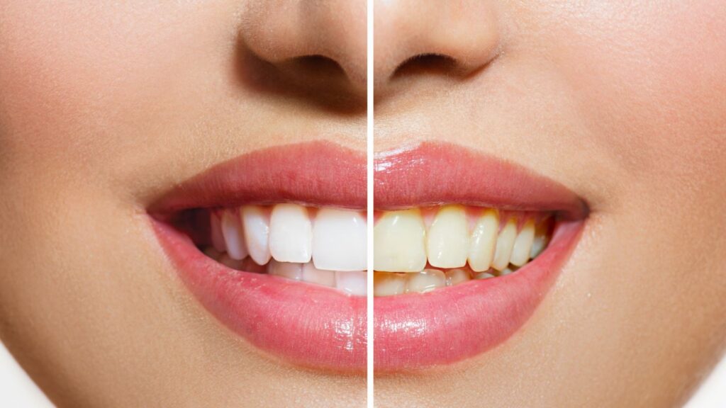 Before and After Teeth Whitening Comparison